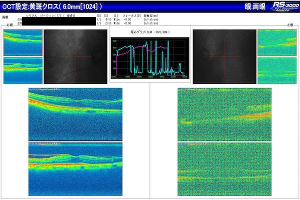  ERMを自然に治療することは可能ですか?