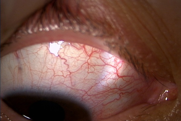 上強膜炎の症状