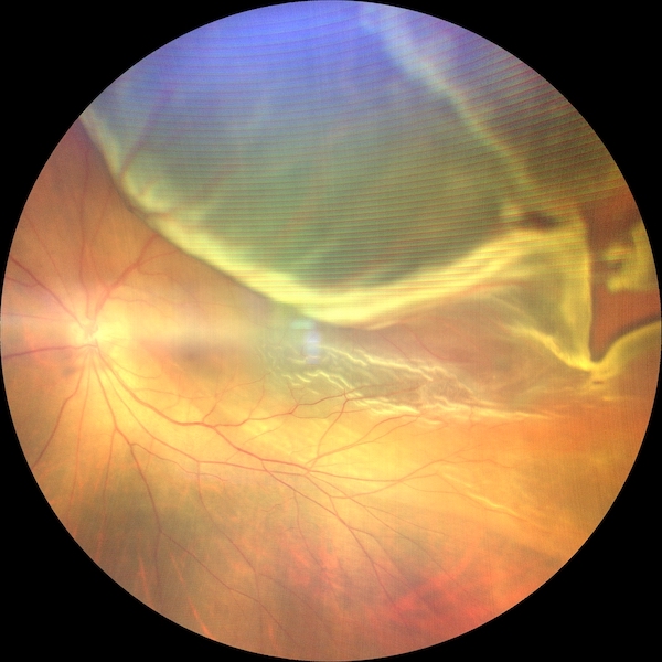 裂孔原性網膜剥離 - 静岡県島田市の眼科【おおるり眼科クリニック】