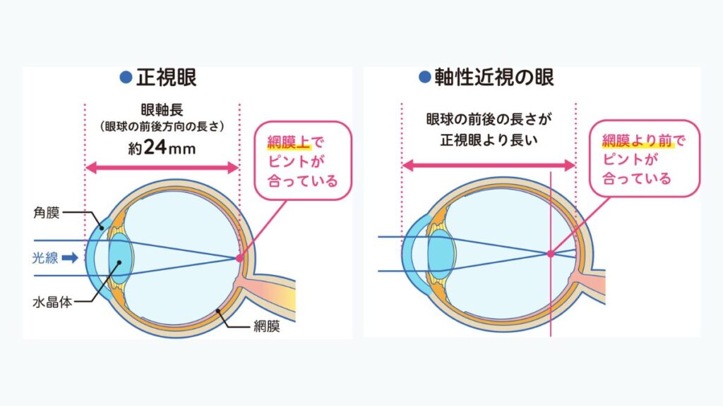 正視と近視の違いを示した眼球の図