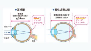 正視と近視の違いを示した図。正視では光が網膜の上で、近視では網膜の手前でピントを結びます