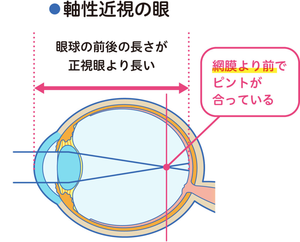 軸性近視では眼球が長くなり網膜より前でピントが合う