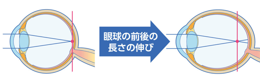 軸性近視では眼球が長くなり網膜より前でピントが合う