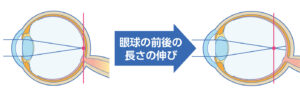 軸性近視では眼球が長くなり網膜より前でピントが合う
