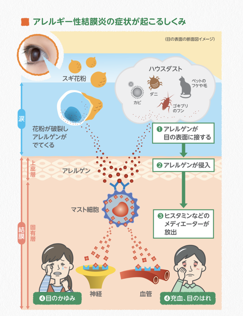 花粉やハウスダストなどのアレルゲンが結膜に侵入し、マスト細胞からヒスタミンなどが放出されて、目のかゆみや充血が起こる仕組みを示した図解。